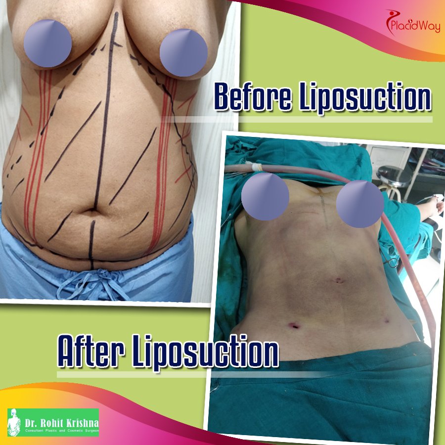 Before and After Liposuction in India